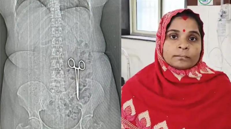 Doctors leave scissor inside woman body during treatment news in hindi