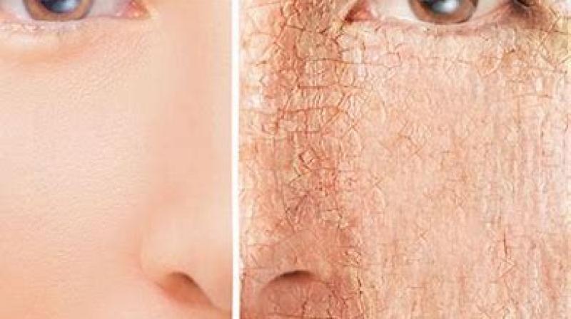 If you are troubled by cheeks and skin cracks in winter, then try these 5 home remedies