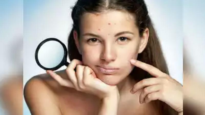 Why are there more pimples during monsoon season? To avoid this, follow these tips