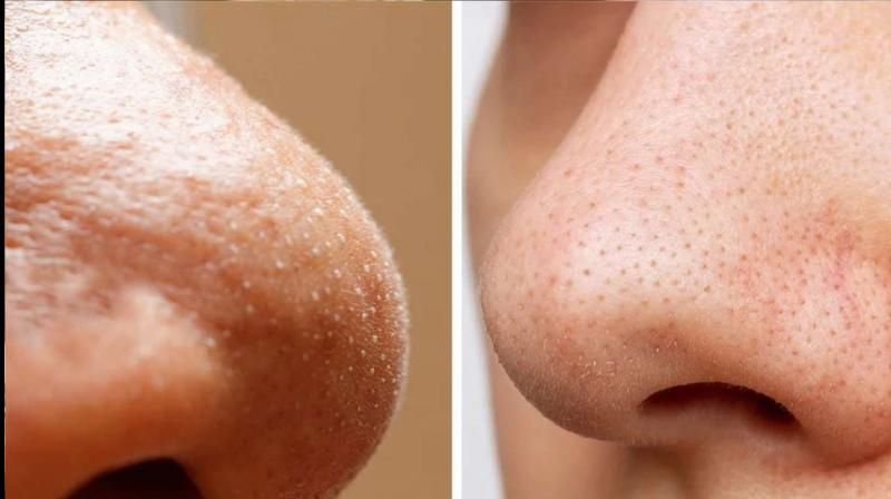 Whiteheads vs Blackheads: Know the difference between the two and 5 home remedies to treat them