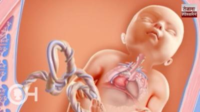 11-Year-Old with Rare Congenital Diaphragmatic Hernia Successfully Operated at SMS Hospital