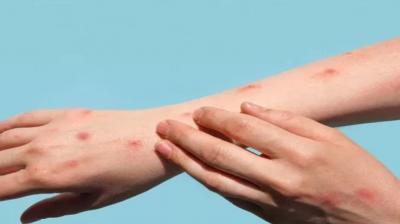 Increased risk of monkeypox! 6 hospitals ready in Delhi news in hindi