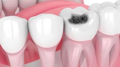 Say goodbye to cavities with this kitchen ingredient News In Hindi